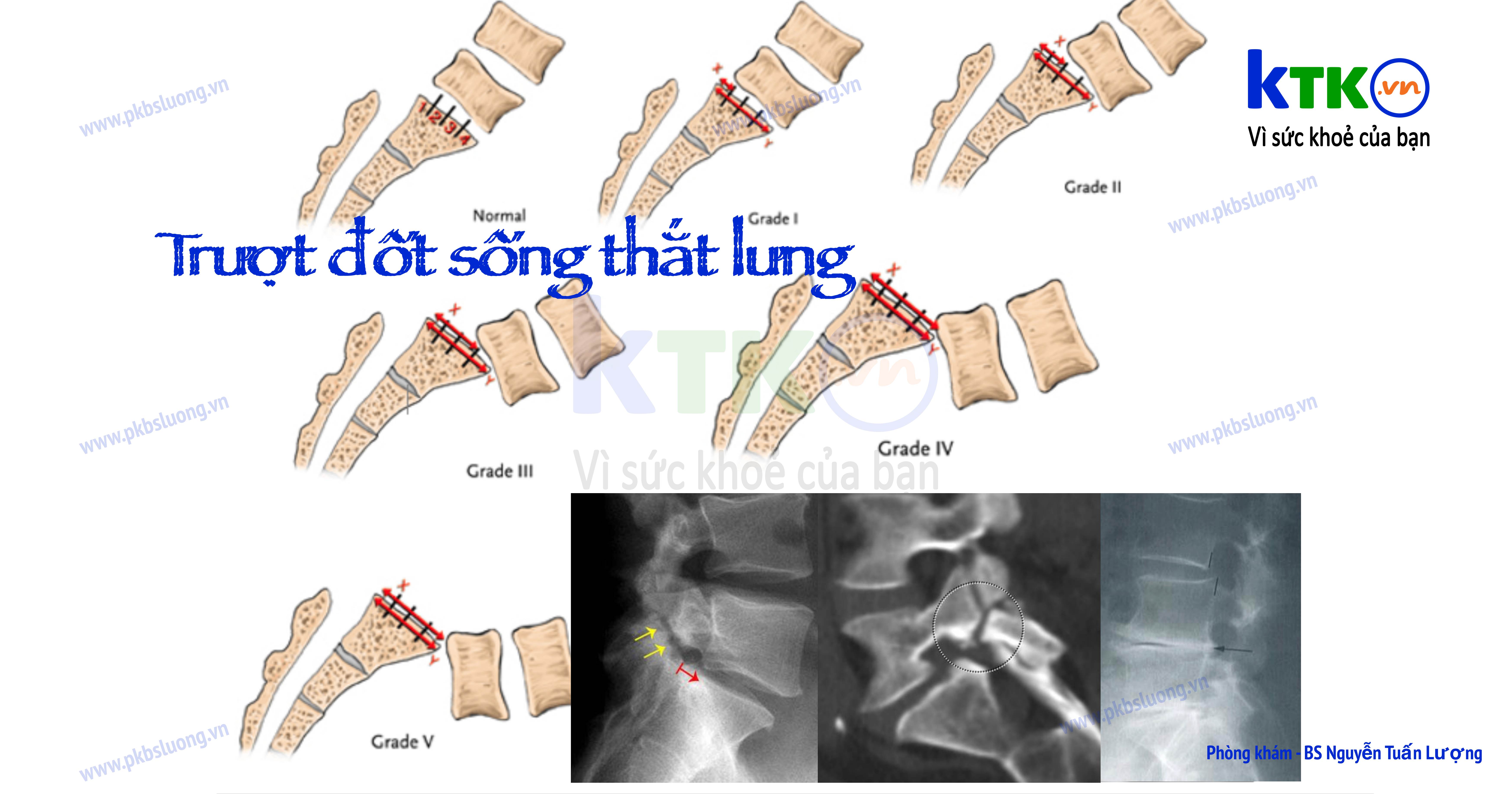 Trượt đốt sống thắt lưng biểu hiện như nào?